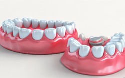 2025全口修复怎么选？种植牙VS全口假牙，哪个更划算？