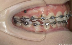 二类错颌畸形手术方法有哪些？选择标准与应用要点是什么？