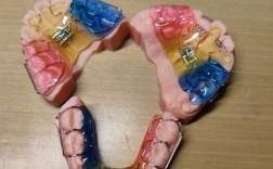 正畸固定扩弓病例的临床关键点有哪些？
