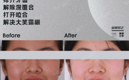 矫正牙齿会导致牙龈外露吗？