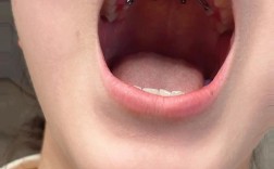 矫正牙齿开口图是什么？如何通过它看懂矫正效果？