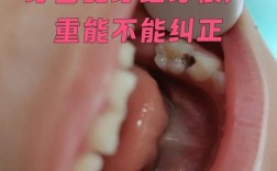 龋齿多还能矫正牙齿吗