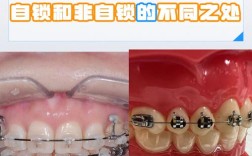 牙齿矫正自锁托槽图片