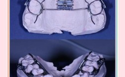 隐形矫正牙齿视频教程能自己完成整个矫正过程吗？