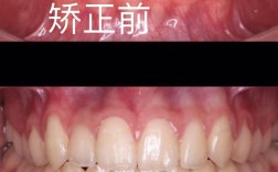 牙齿往内凹矫正前后对比图效果差异有多大？