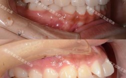 成都隐适美矫正效果如何？体验怎么样？