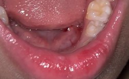 矫正牙齿后牙龈肿痛怎么办？