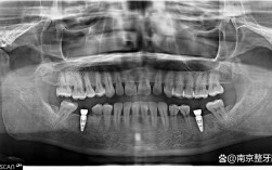 南京种牙哪边好？求靠谱机构推荐？