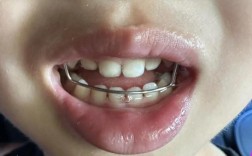 儿童地包天矫正黄金期是几岁？不治会影响脸型吗？