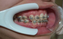 关节好了就可以正畸吗？