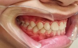 地包天 先手术 后正畸