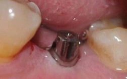 牙周植骨需要什么条件