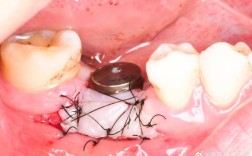 游离末端缺失修复方法的关键技术及优化方向是什么？