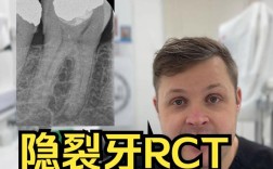 牙齿矫正会导致牙隐裂吗？图片解析原因与应对