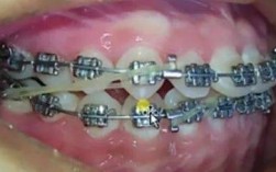 正畸牵引钩使用会导致嘴部不适吗？