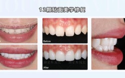 美加牙贴面拆除方法有哪些？哪种更安全？