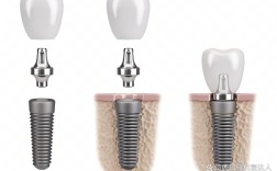 成都哪里植牙最好