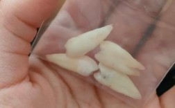 牙齿矫正非得拔4颗牙吗？会有什么影响？