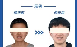 矫正牙齿会改变牙床形态吗？