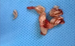 智齿弯根拔出难不难？具体方法和步骤是怎样的？