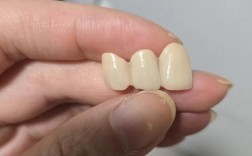 南京牙齿矫正和烤瓷牙怎么选？效果与价格哪个重要？