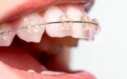 正畸中圣马特托槽