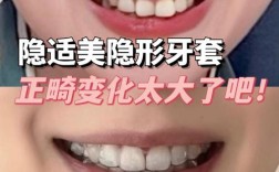 隐形矫正牙齿到底是什么？