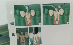 氧化锆粘结方法
