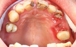 正畸期间牙齿卫生如何维护？清洁要点有哪些？