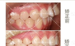 中山牙齿正畸哪家好？选机构该看重口碑、技术还是效果？