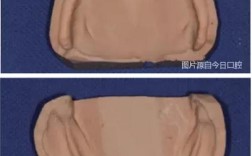 无牙合患者的印模方法有哪些？不同技术如何影响义齿适配性与长期稳定性？