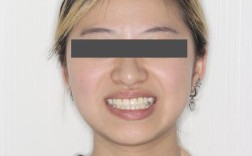 轻微双颌前突正畸，矫正有必要吗？效果如何？