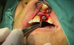 缺牙25年，种牙能恢复咀嚼功能吗？