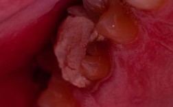 正畸过程中牙齿流血