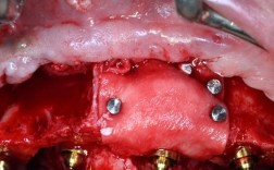 种牙植骨后发烧怎么回事？是正常现象还是需要担心？