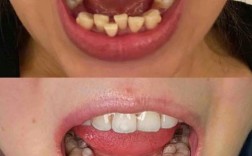 沈阳隐形牙齿矫正效果如何？价格贵不贵？