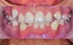 正畸牙齿为何会拥挤？如何有效改善矫正效果？