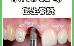 全口种牙是否足够坚固耐用？