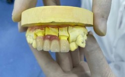 正畸陶瓷牙托脱落