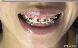 成都牙齿外科矫正效果好不好？有没有风险？术后要注意什么？