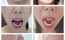 双层牙齿后期矫正