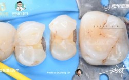 冷牙胶充填方法的关键步骤和注意事项是什么？