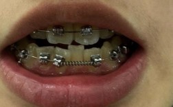 正畸换弓丝有臭味？是什么原因导致的？