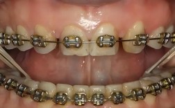 正畸牵引勾放置位置有何讲究？