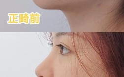 牙齿矫正几个月有变化