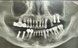 植骨后牙颌骨能种牙吗？需要多久能种？成功率如何？