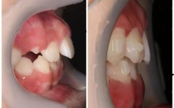 矫正牙齿后反弹照片