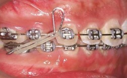 正畸垂直开大曲弯制