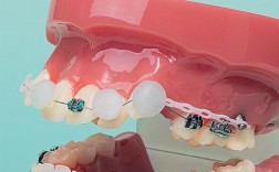 正畸蜡会美观点吗