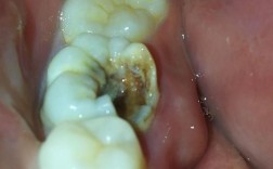 牙齿矫正牙根发痒，是牙齿移动的正常反应吗？